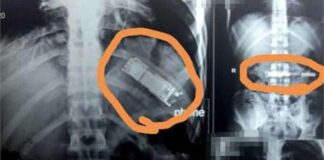 इस शख्स के पेट में 6 महीने से पड़ा हुआ था मोबाइल, एक्स-रे देख हैरान हुए डॉक्टर